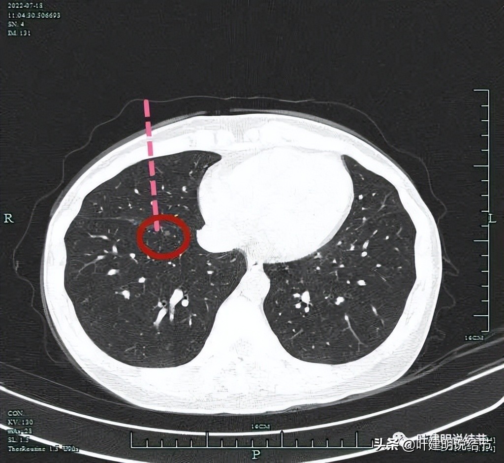 2cm的肺磨玻璃结节如何处理最合适,年轻女人磨玻璃结节
