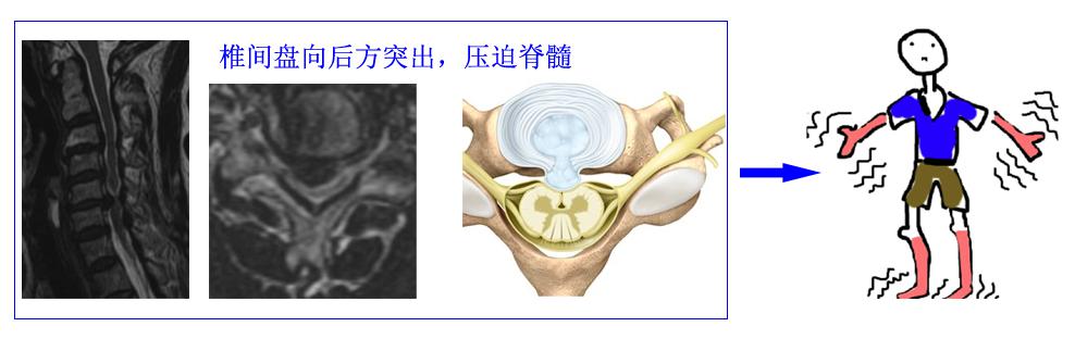 颈椎病是什么病要怎么治,颈椎病是怎样的症状