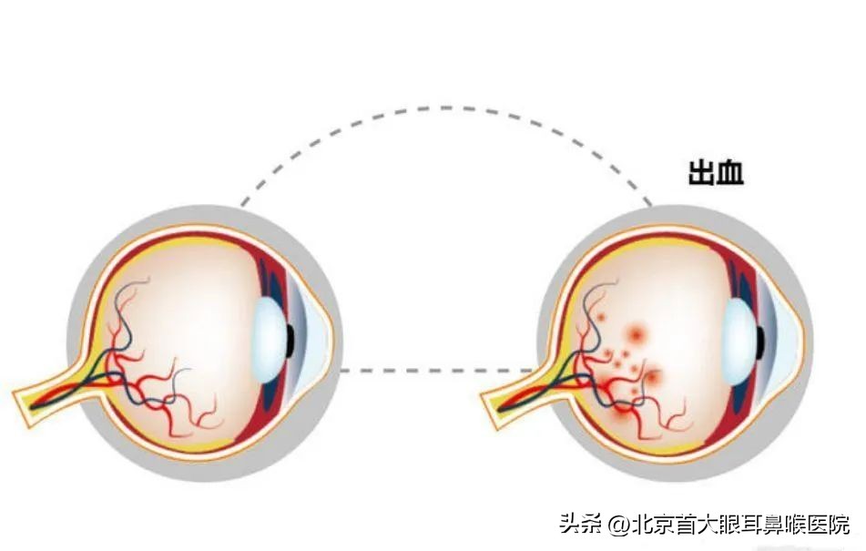 北京同仁医院眼底出血最权威专家,北京看眼底病哪个医院最好