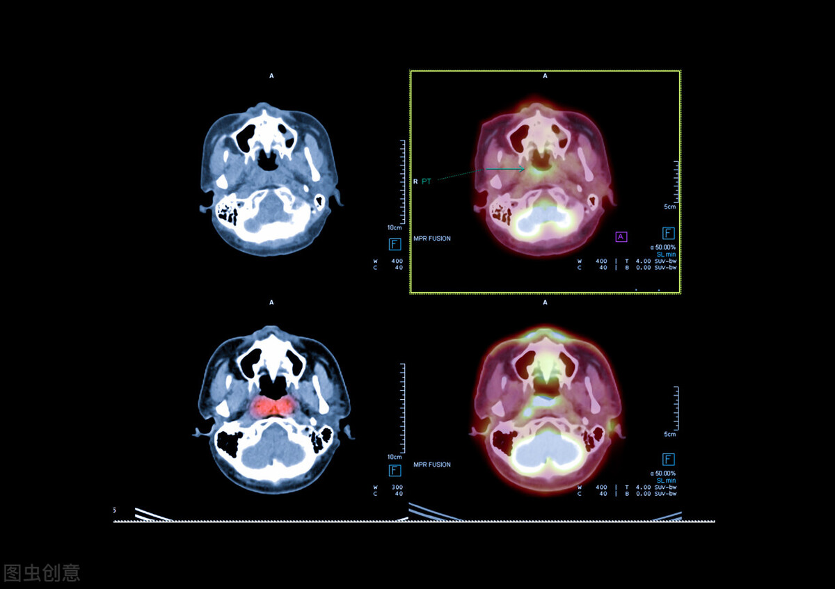 鼻咽癌化疗患者,鼻咽癌中晚期化疗的全过程视频