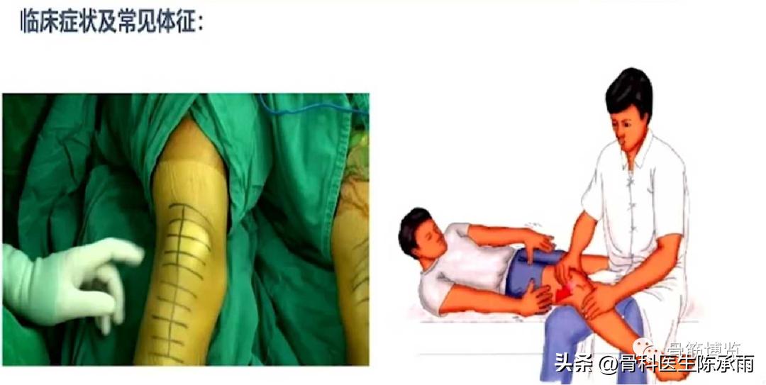 什么是髌骨脱位,贵宾狗髌骨脱位