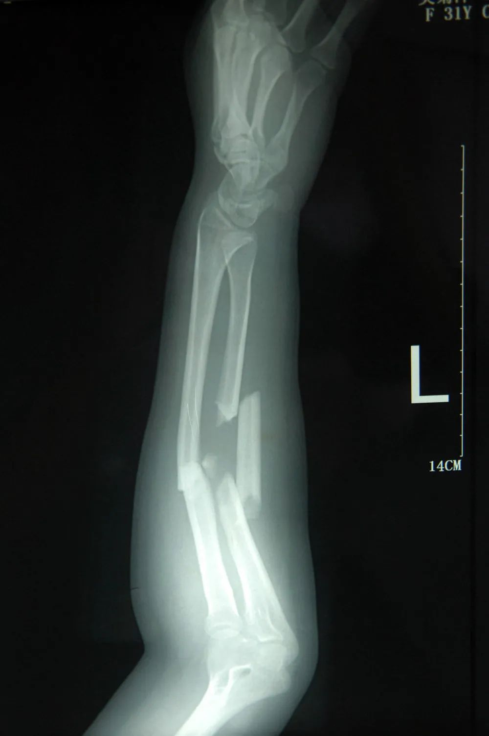 8人用被子接住坠楼女孩视频,小孩坠楼女子徒手接住