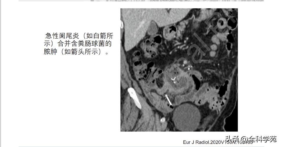 阑尾炎的讲解,关于阑尾炎的讨论总结