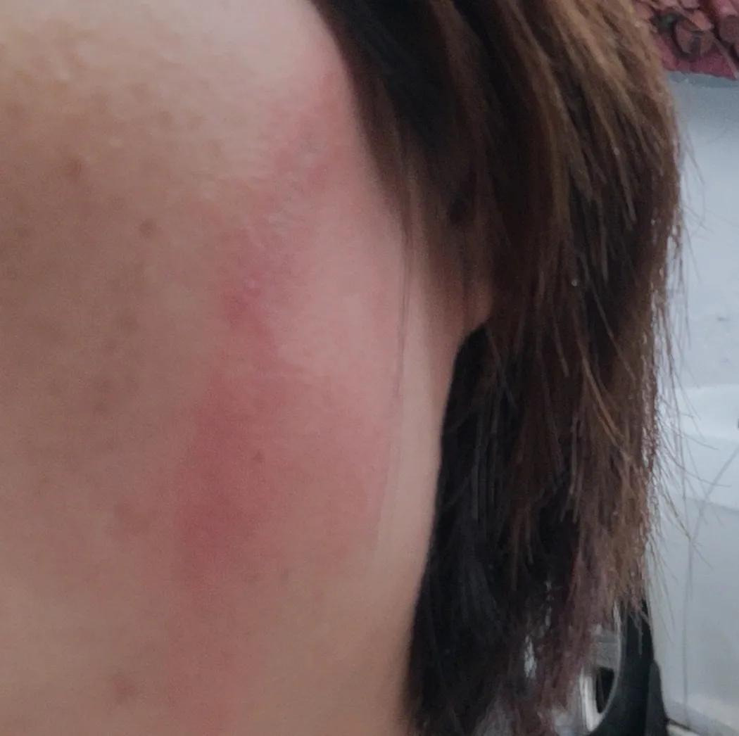 我被隐翅虫咬了（附处理方法）