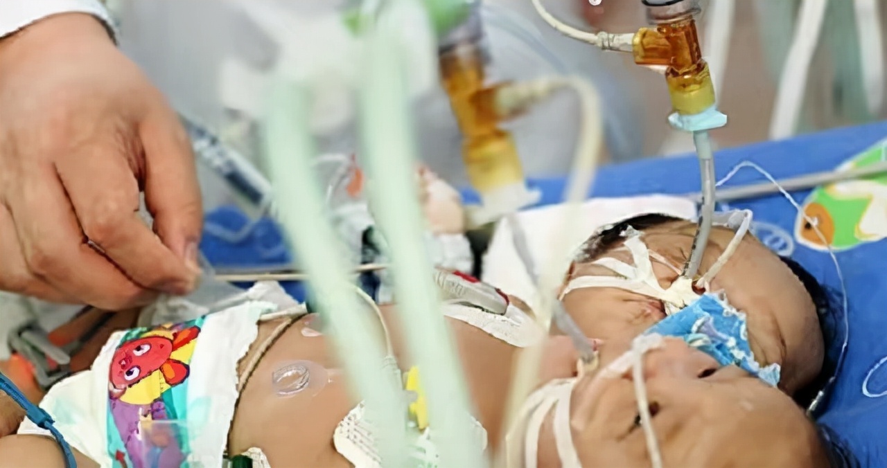 中国首例双头婴儿现状如何,全国首例双头婴儿现在咋样了