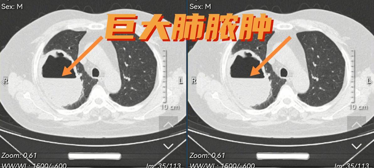 女52岁咳嗽咯血的ct诊断,老是咳嗽结果是肺脓肿