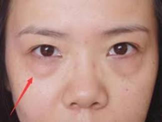 眼袋和卧蚕有什么区别怎么祛眼袋,眼袋可以改善成卧蚕吗
