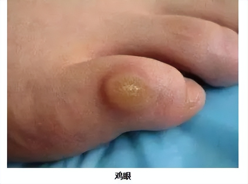 脚上长跖疣和鸡眼有什么区别,脚底透明凸起是鸡眼还是跖疣