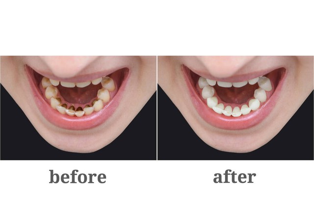 去除牙菌斑最有效的方法,牙菌斑要怎么去除最简单的方法