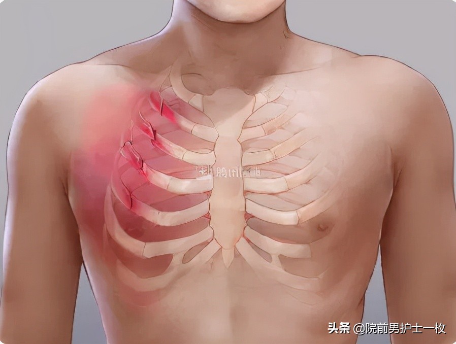 多发肋骨骨折什么意思,多发肋骨骨折怎么治疗