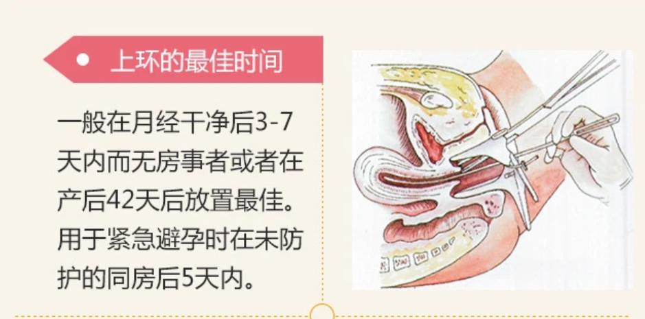 女性上环的全过程，看完心疼了！男女都要好好看看，珍惜眼前人