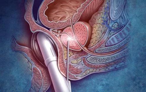 80岁老人前列腺癌骨转移能放疗吗,80岁前列腺癌骨转移能活多久