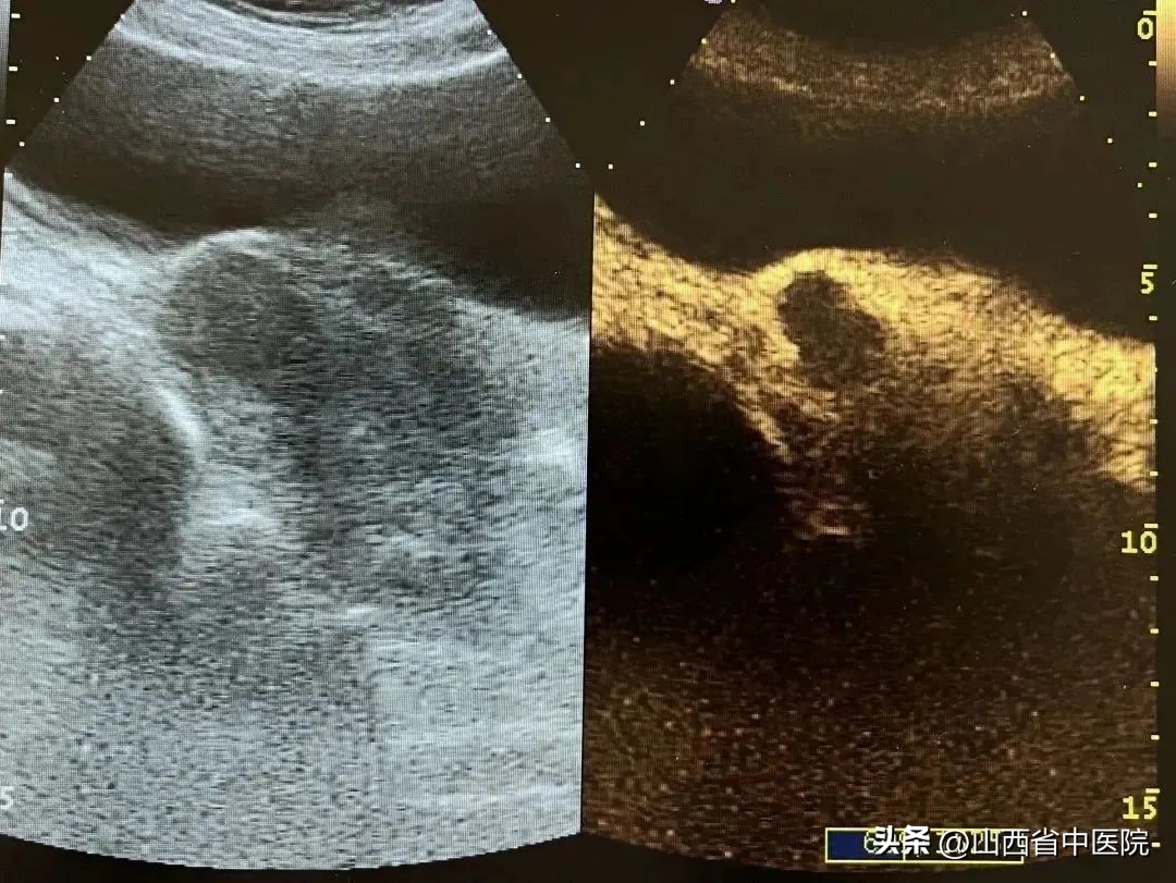 山西有介入手术治疗子宫肌瘤的么,不开刀去除子宫瘤