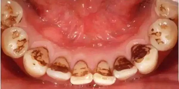 牙齿内部发黄是怎么回事怎么解决,牙齿发黄清洗小妙招