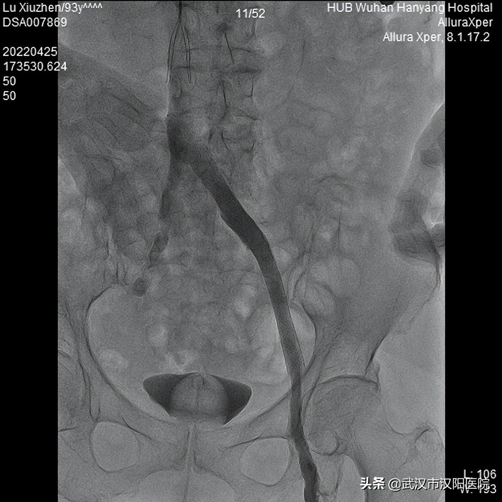 93老年人腿上有血栓怎么治,92岁老人腿血栓手术成功率有多高