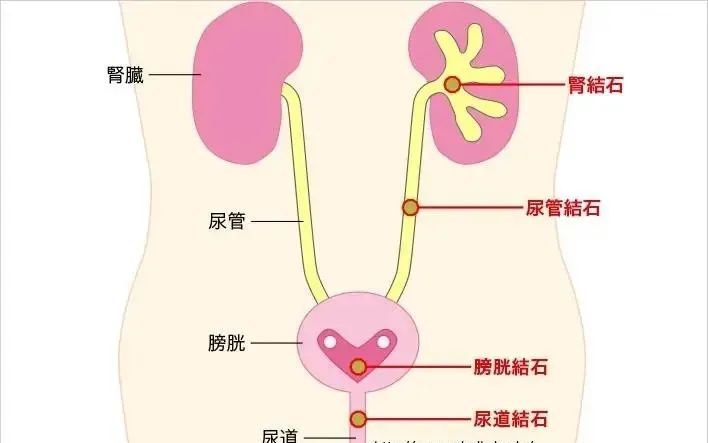 出现血尿并伴有腰疼什么原因,结石血尿腰痛怎么办啊