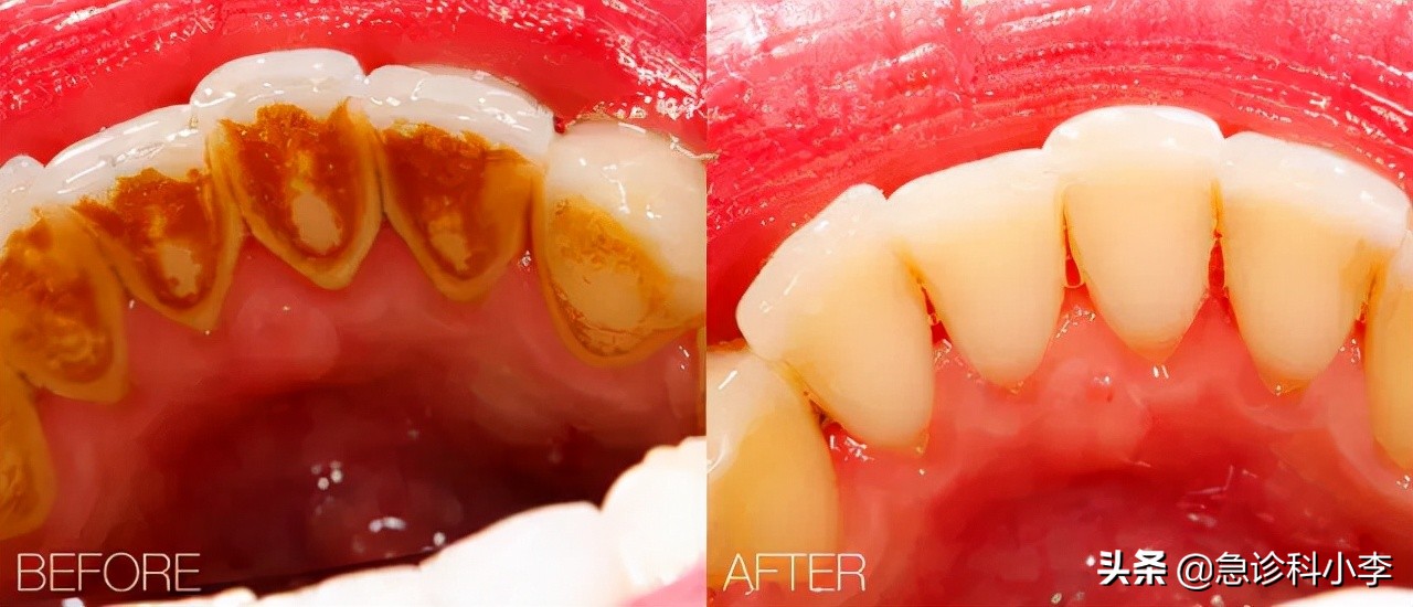 牙缝里的牙结石如何清除干净,在牙缝里的牙结石要怎么去除
