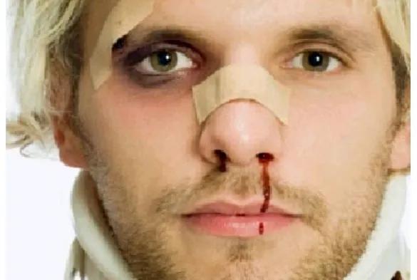 鼻出血介入治疗,鼻出血快速止血