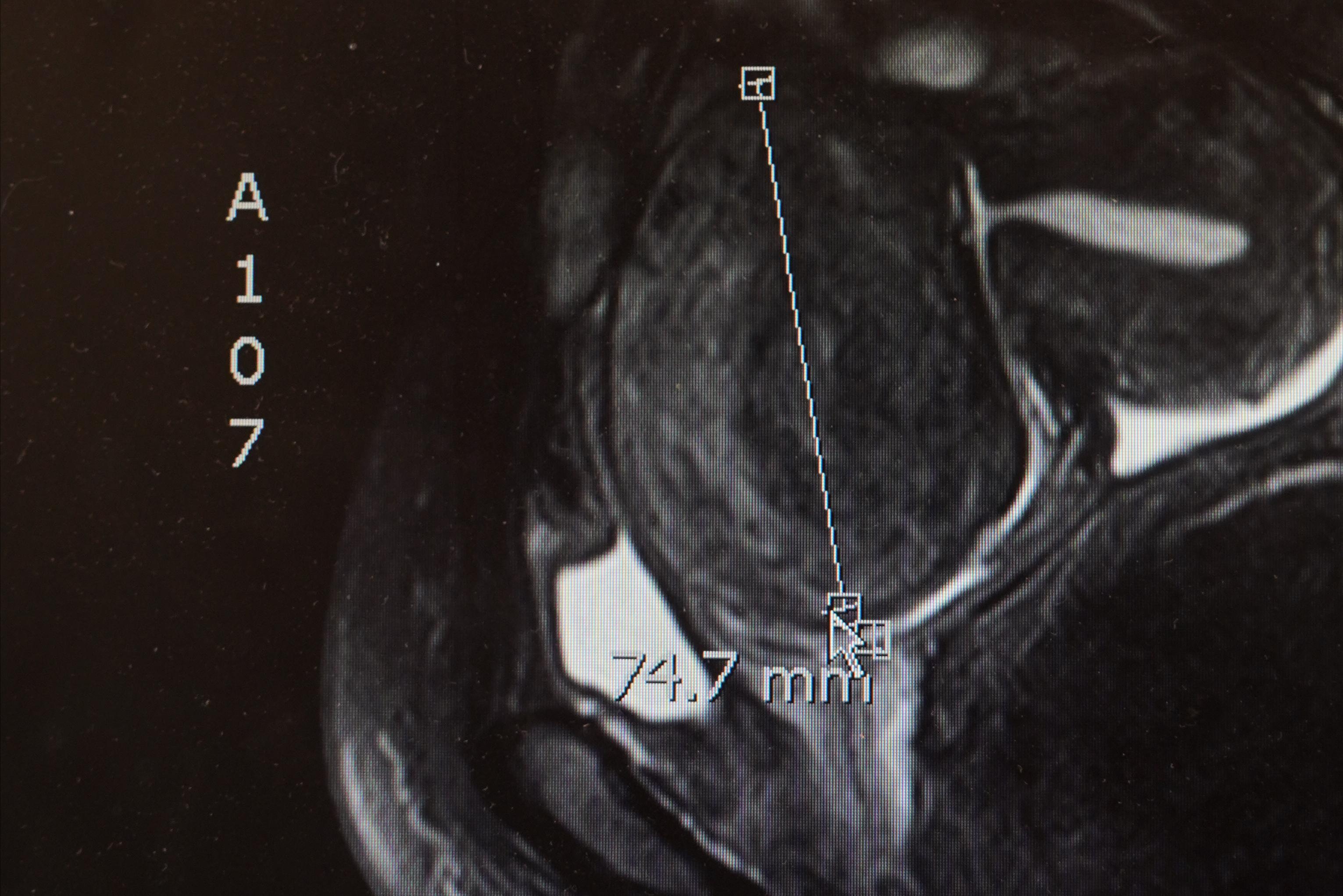 老婆子宫切了怎么办,子宫肌瘤把子宫全切了很后悔