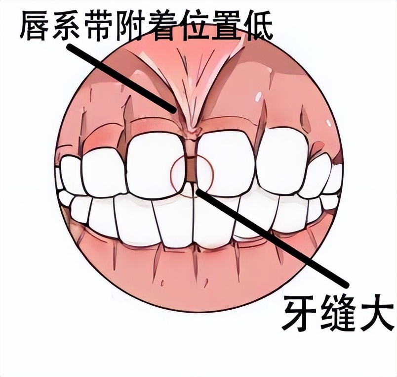 门牙缝隙很大影响颜值,门牙缝隙大影响说话清楚吗