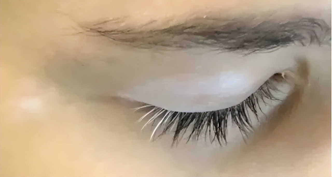 汗毛变白是不是已经变成白癜风了,毛囊型的白癜风会导致毛发变白么