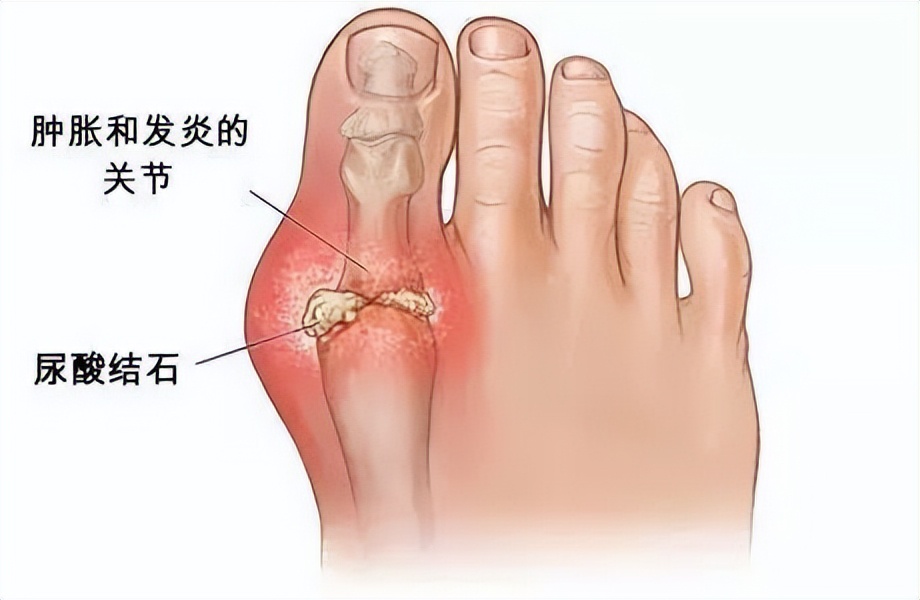 长期关节炎疼痛解决最好办法,小关节疼痛是怎么治愈