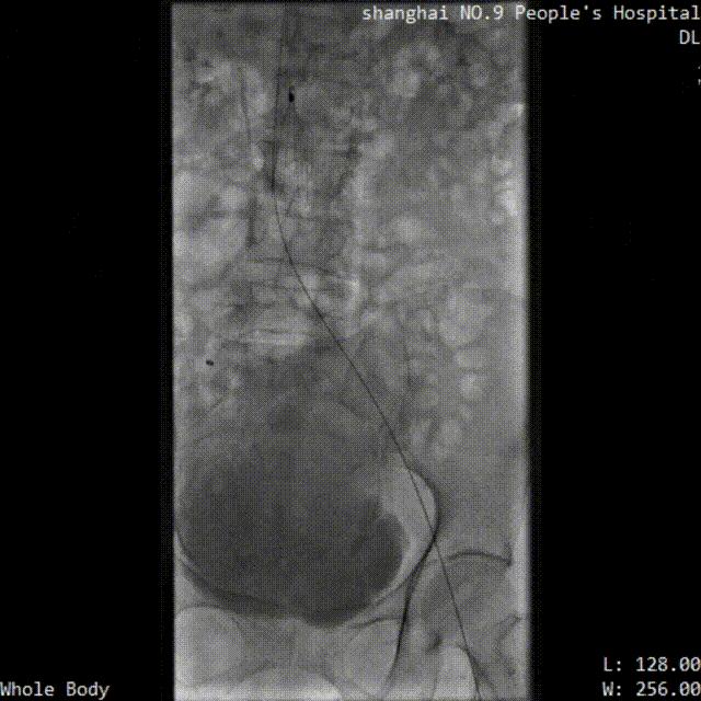 中国医院血栓清除技术,血栓消除的高端技术