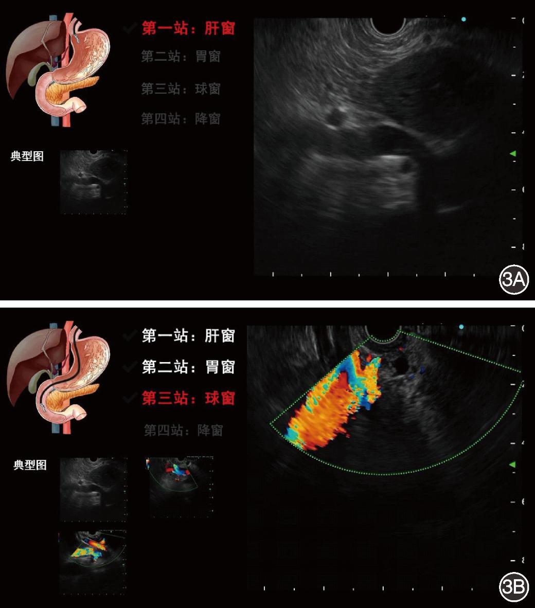 基于深度学习的内镜超声胆管扫查辅助分站系统构建