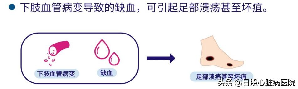 腿脚发凉别大意可能是大病,腿脚冰凉是不好的征兆吗