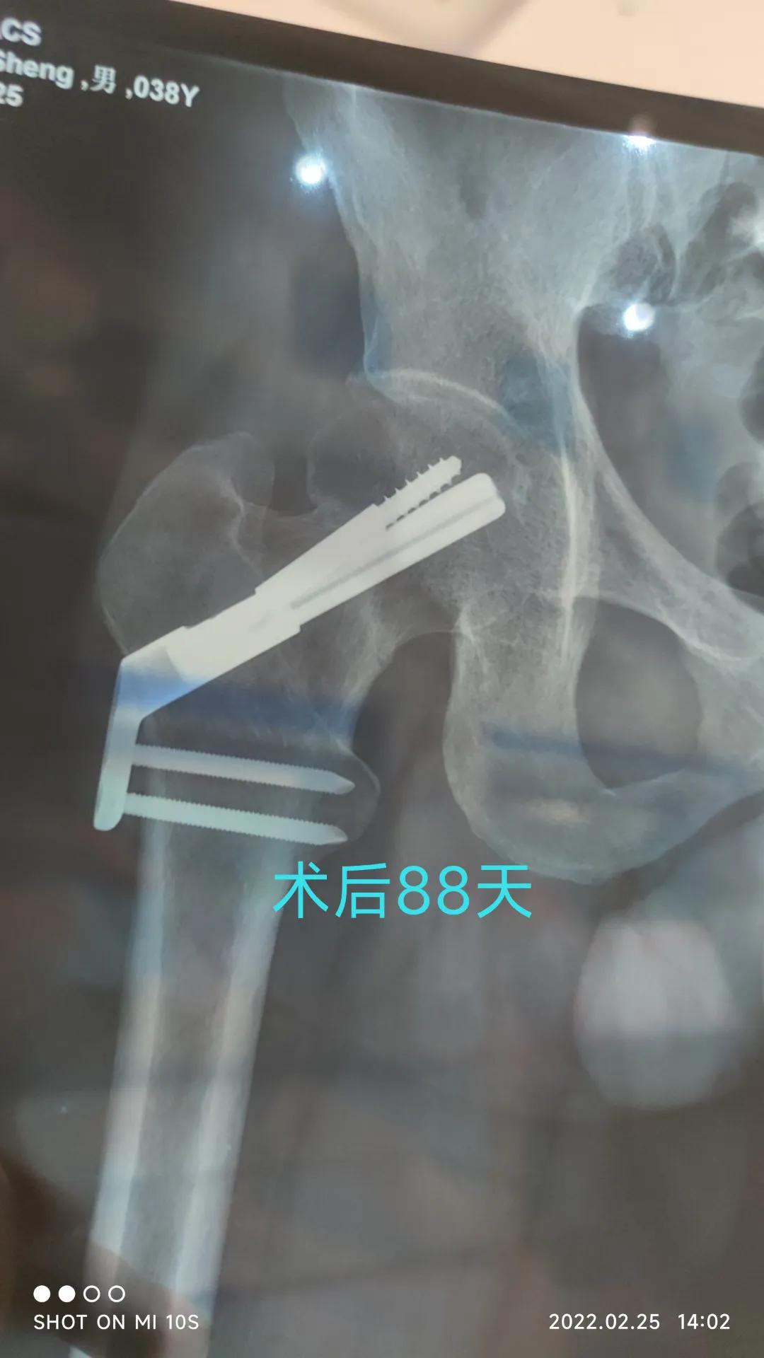 股骨颈骨折康复治疗,股骨颈骨折内固定康复