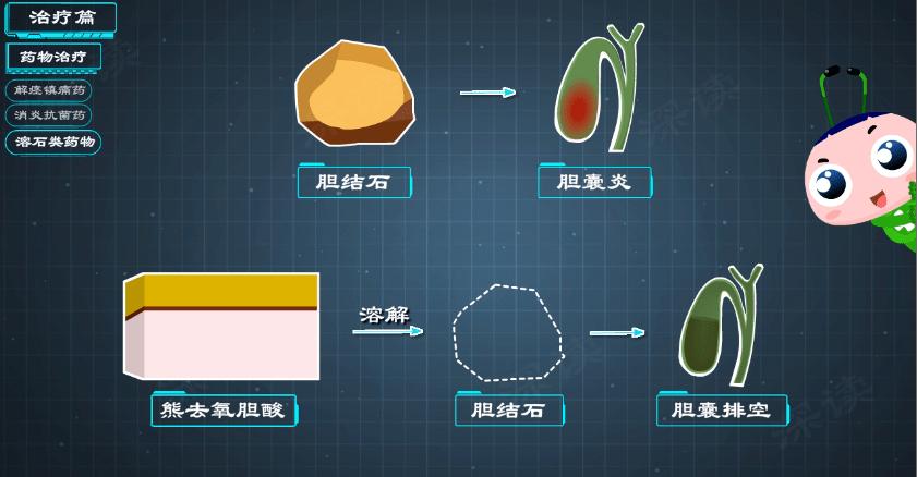 胆囊炎胆结石如何正确治疗,胆囊炎胆结石治疗方案