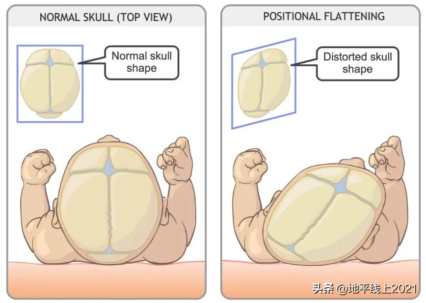 想让孩子有一个漂亮的头型，如何预防和治疗偏头与扁头？