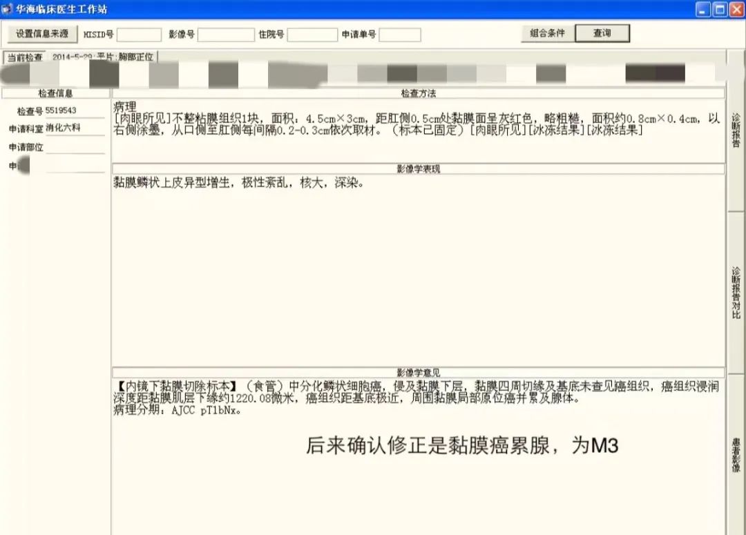 病例档案纪录片,食管早期癌的内镜筛查