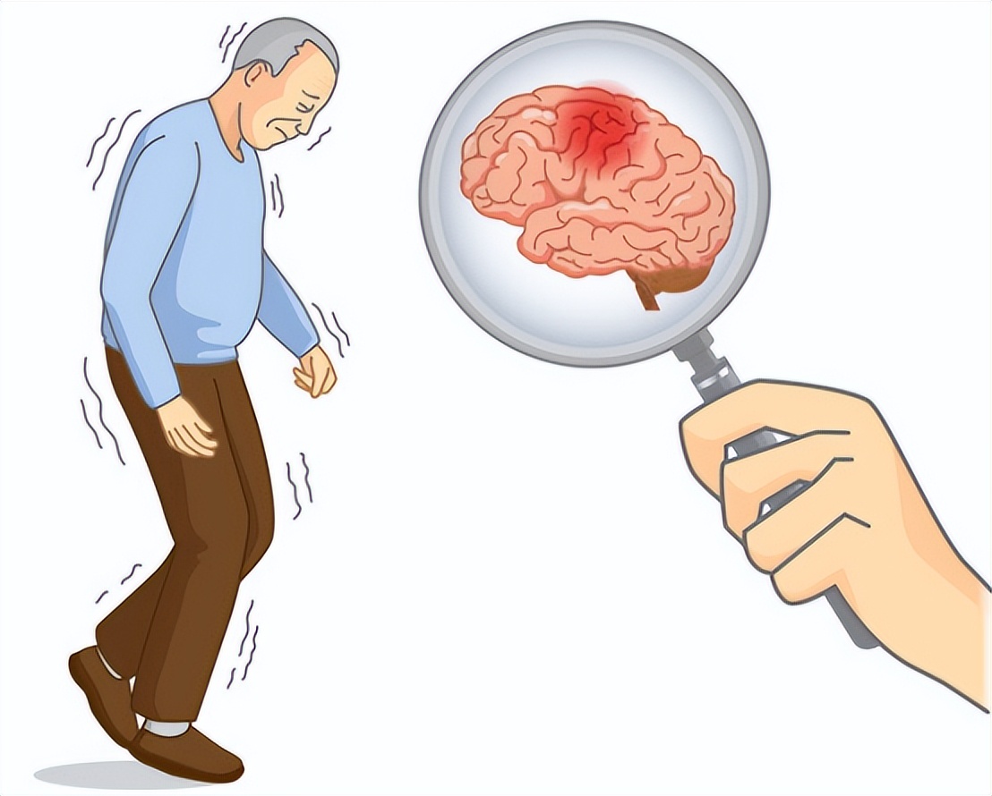 民间土方治疗脑中风,脑中风是什么原因和征兆