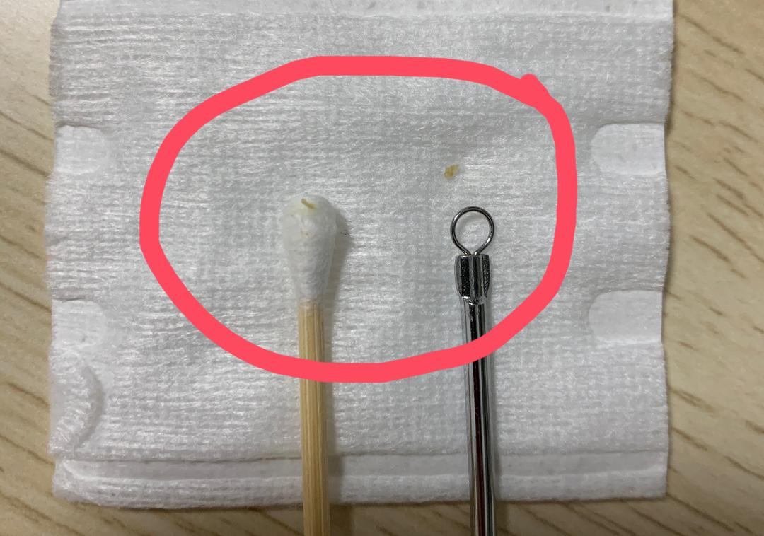 战胜痘痘重拾自信,对抗痘痘常用药膏