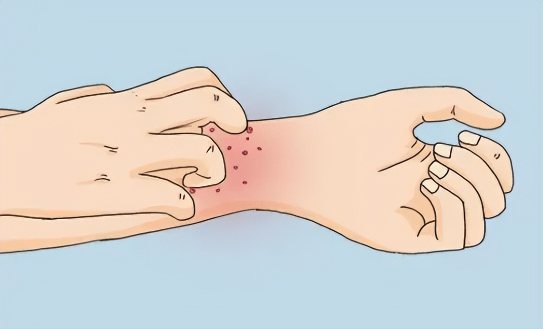 每个人身上都有疣,身上四种疣