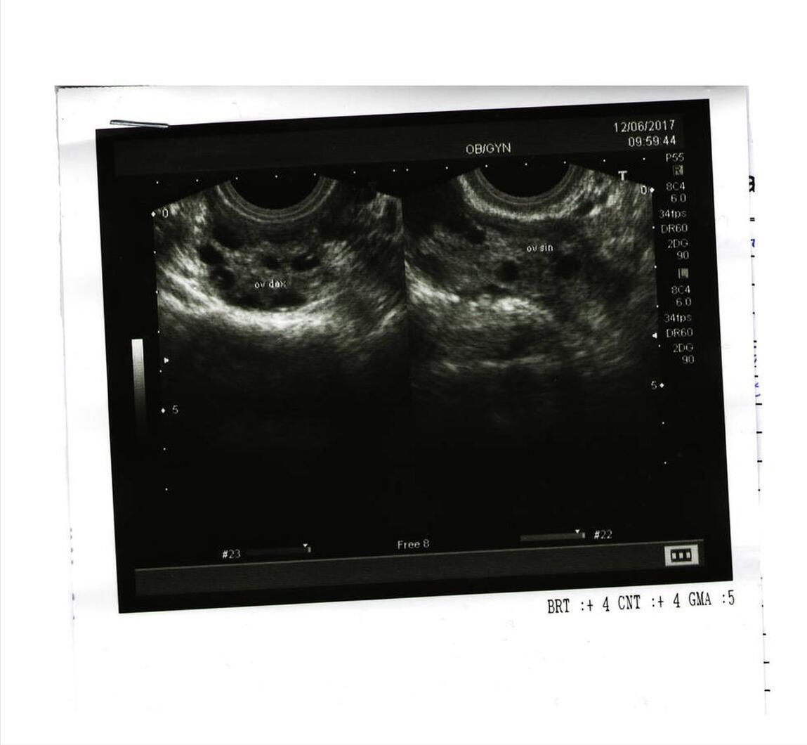 靠近卵巢有个囊肿,卵巢囊肿是不是被气出来的