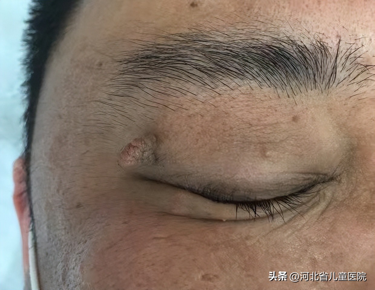 脖子上很多小肉揪图片,脖子长个肉揪揪怎么去除