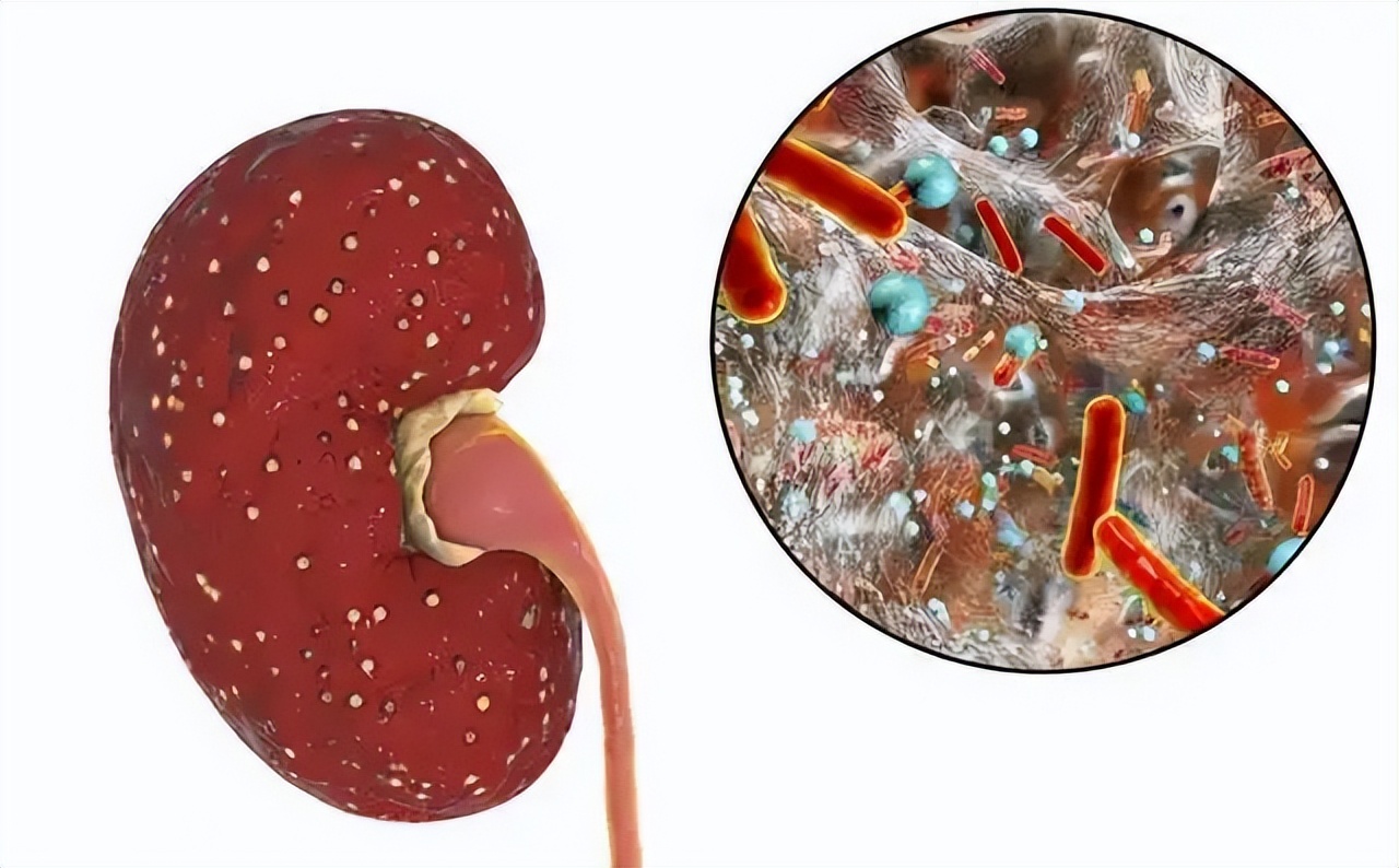 肾小球肾炎能治愈吗,肾小球肾炎还能自愈吗