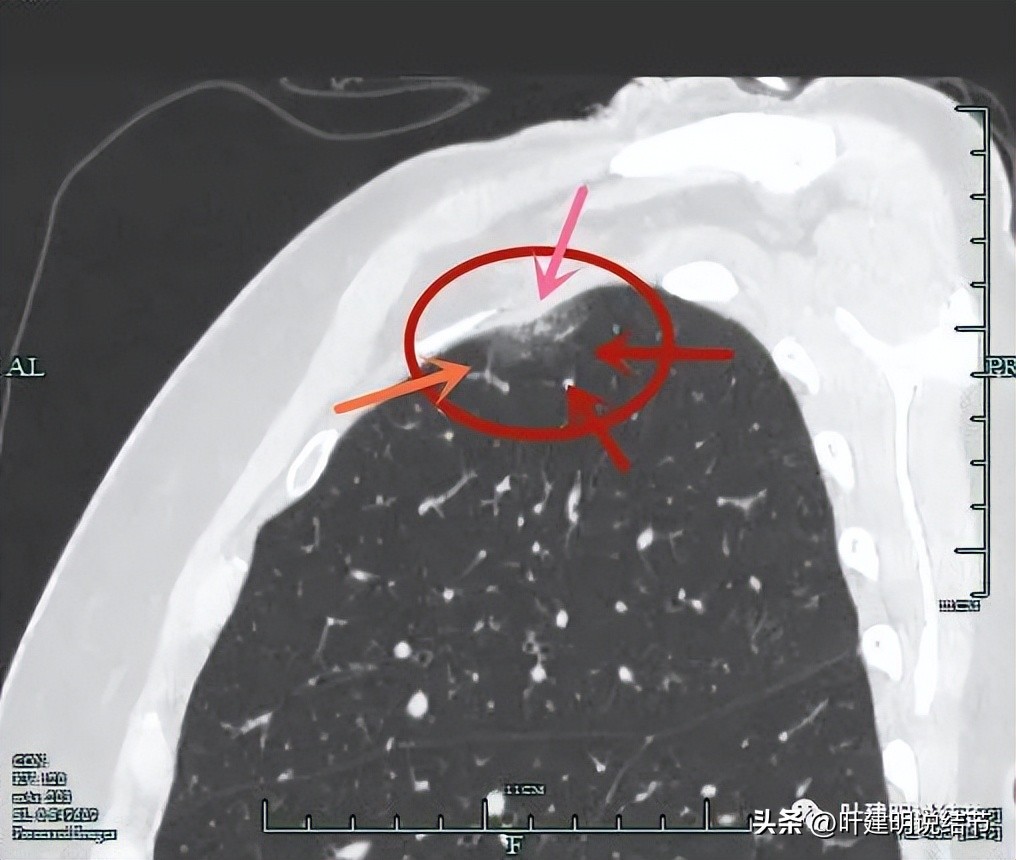 肺癌病理的肿块是硬的吗,肺癌病灶什么样