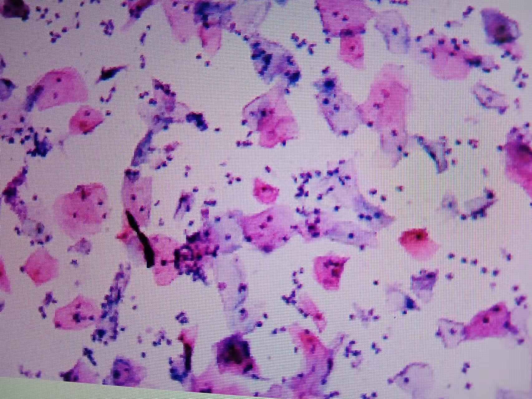 宫颈癌——有望成为被消灭的第一个癌症