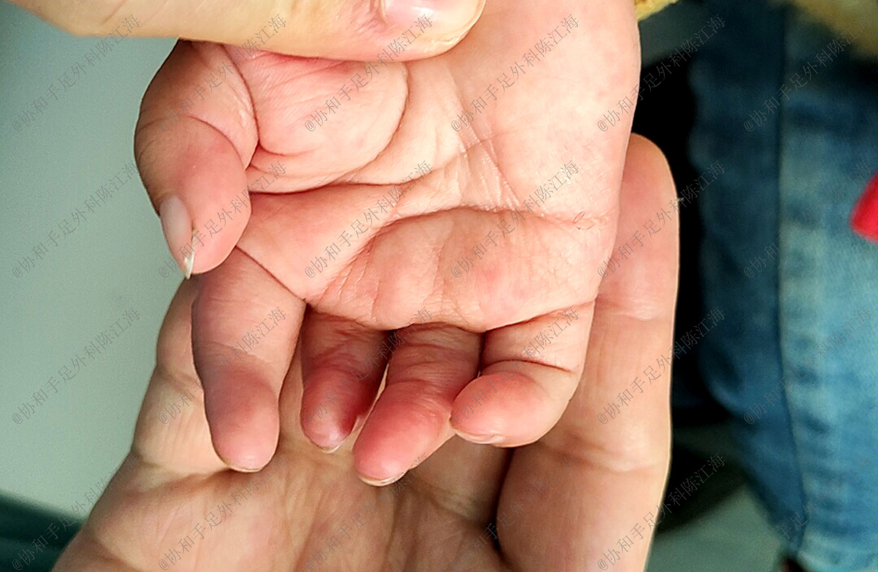 6个月宝宝手短,六个月宝宝手指肿胀怎么回事