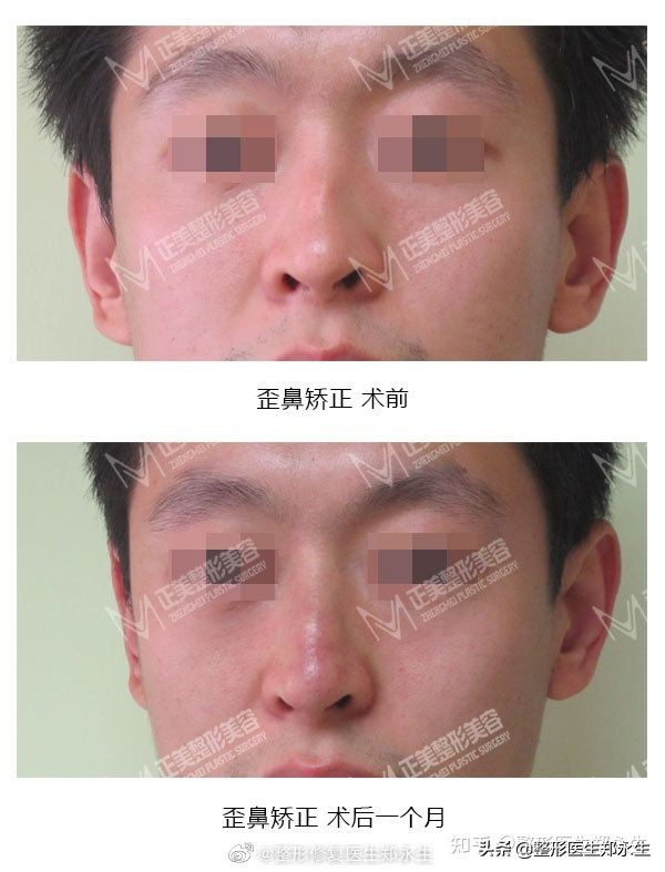截骨歪鼻矫正术多少钱,歪鼻矫正必须要截骨吗
