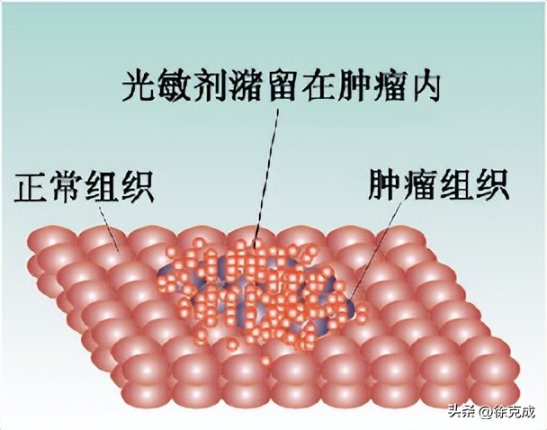 徐克成大讲堂,徐克成谈癌症克星