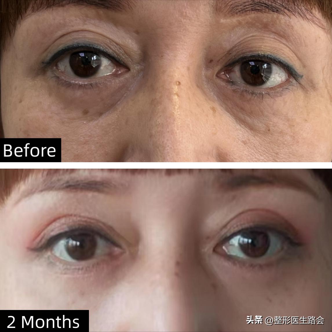 40岁泪沟用什么填充最好,40岁眼袋泪沟最好的解决方法