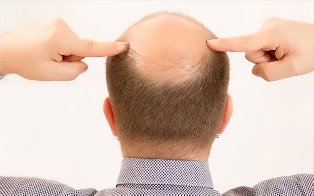 中年男人斑秃脱发的原因有哪些,女性中年脱发是什么原因