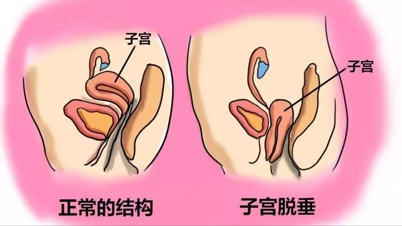 女性没了子宫之后和正常人有什么区别？身体的变化，让你无法忽视