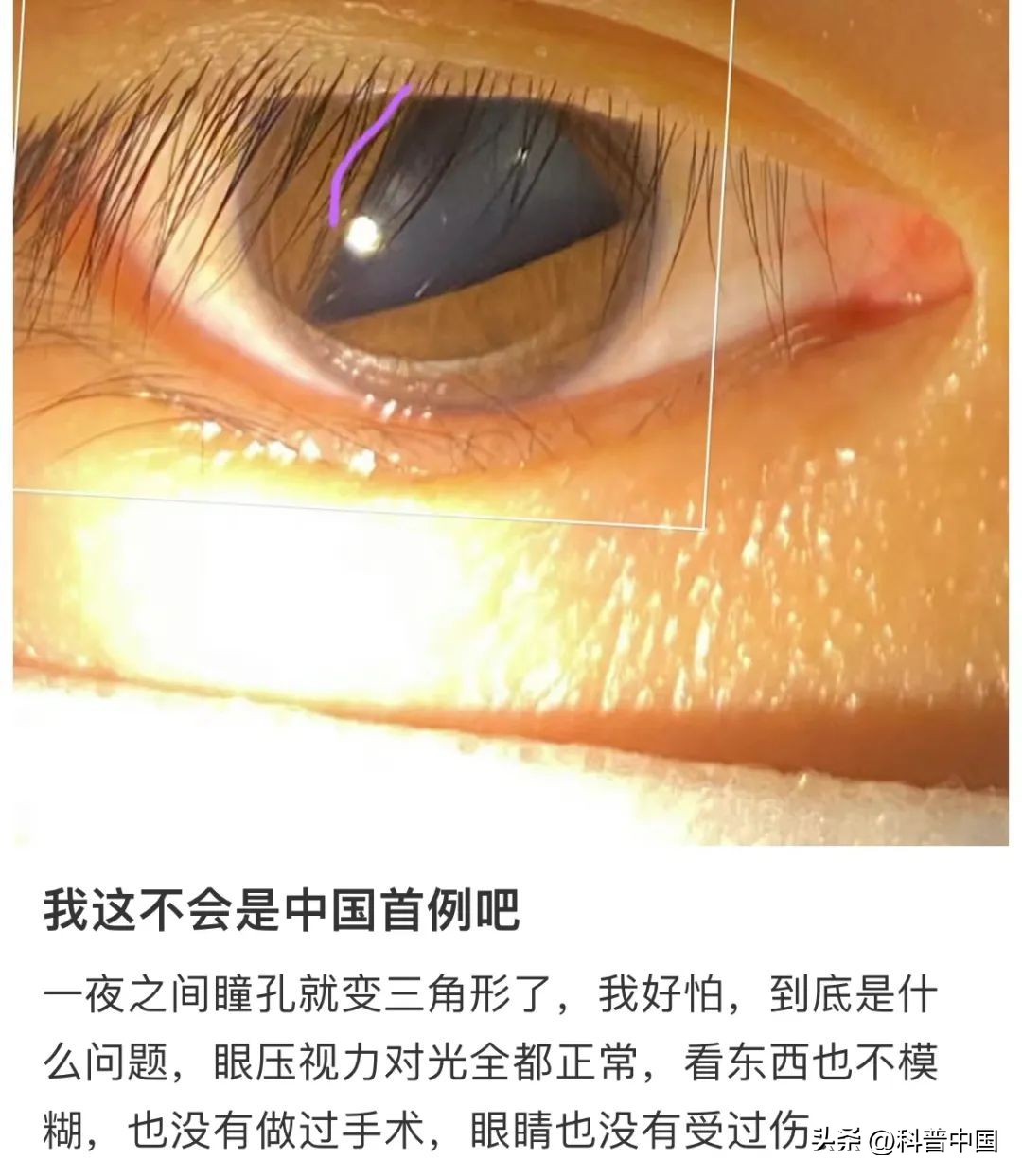 瞳孔三角形后遗症,瞳孔变成三角形是什么原因