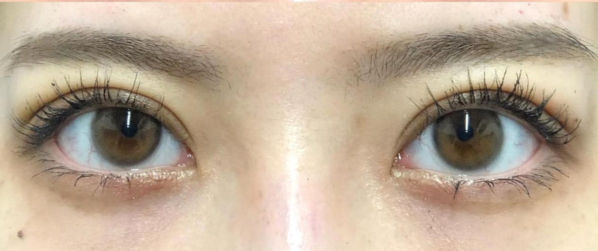 单眼皮肿眼泡去脂肪后适合埋线吗,单眼皮肿眼泡可以割薄一点吗