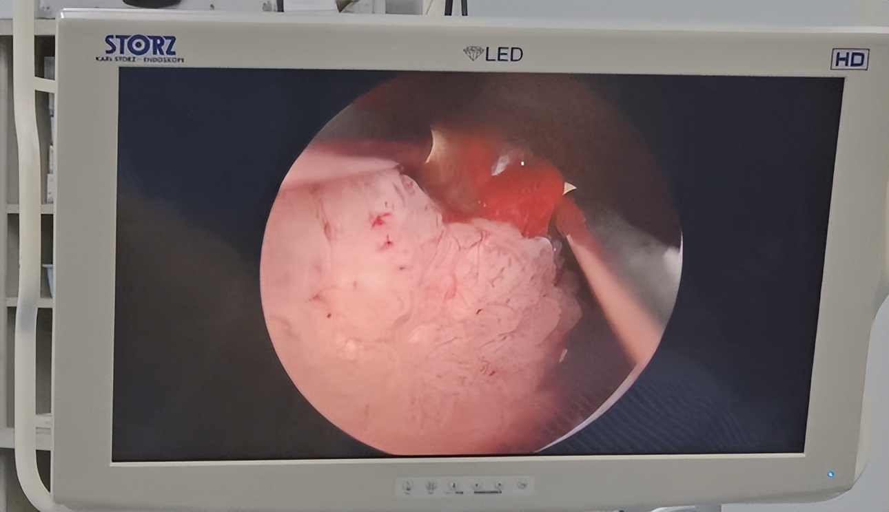 膀胱癌的诊断与鉴别诊断,膀胱癌的诊断与治疗